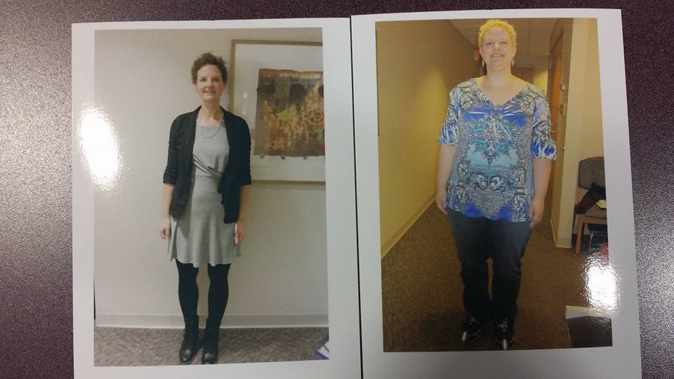 My official before & after pics, approximately 1 year after surgery, 115 pounds lost from first appointment to Nov 6, 2015